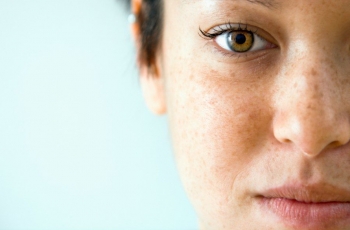 Melasma: 5 tratamentos que amenizam as temidas manchas