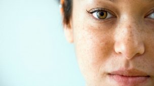 tratamento para o melasma