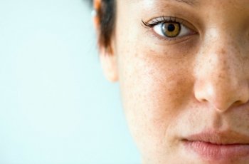 Melasma: 5 tratamentos que amenizam as temidas manchas
