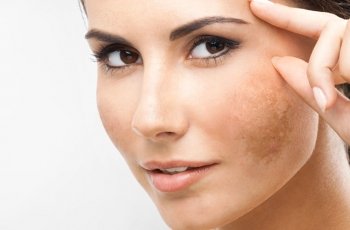 Melasma: o que é e como tratar